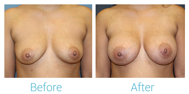 Breast Augmentation Before & After Gallery - Patient 58151779 - Image 1