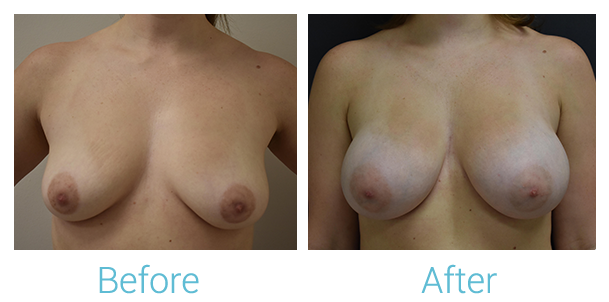 Breast Augmentation Before & After Gallery - Patient 58151780 - Image 1
