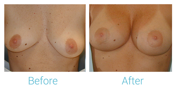Breast Augmentation Before & After Gallery - Patient 58151783 - Image 1