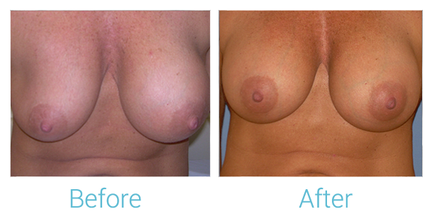 Breast Lift Before & After Gallery - Patient 399907 - Image 1