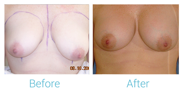 Breast Augmentation Before & After Gallery - Patient 58151787 - Image 1