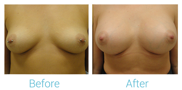 Breast Augmentation Before & After Gallery - Patient 58151793 - Image 1