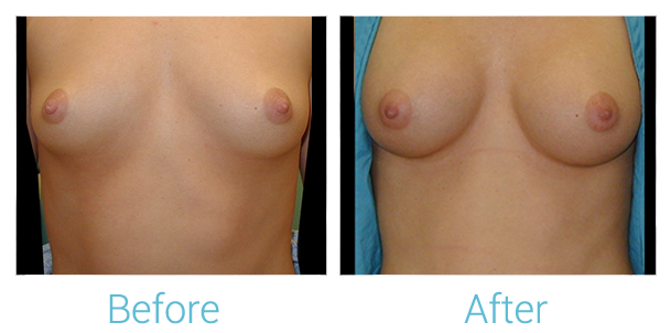 Breast Augmentation Before & After Gallery - Patient 58151795 - Image 1