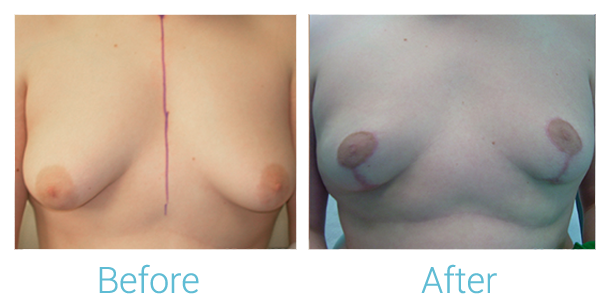 Breast Lift Before & After Gallery - Patient 58151867 - Image 1