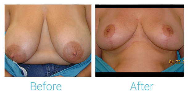 Breast Lift Before & After Gallery - Patient 58151870 - Image 1