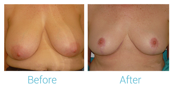 Breast Lift Before & After Gallery - Patient 58151871 - Image 1