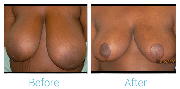 Breast Lift results in Baltimore with Dr. Birely