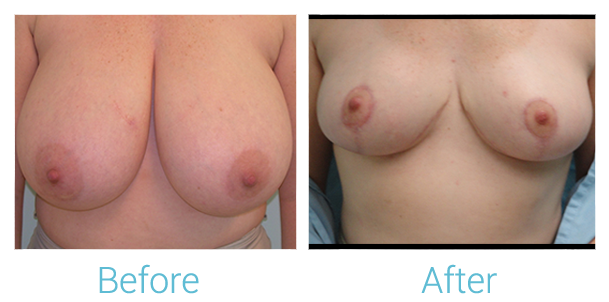 Breast Lift Before & After Gallery - Patient 58151874 - Image 1
