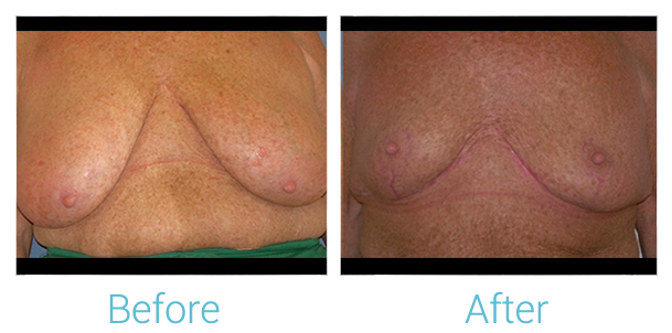 Breast Lift Before & After Gallery - Patient 58151875 - Image 1