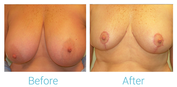 Breast Lift Before & After Gallery - Patient 58151876 - Image 1