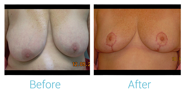 Breast Lift Before & After Gallery - Patient 58151877 - Image 1