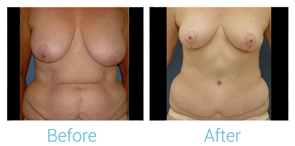 Mommy Makeover Before & After Gallery - Patient 58152028 - Image 1