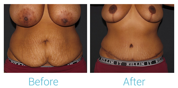 Mommy Makeover Before & After Gallery - Patient 58152030 - Image 1