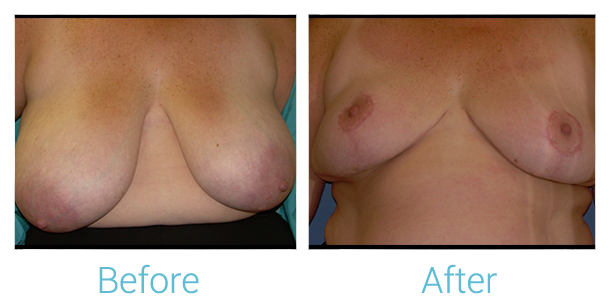 Breast Reduction Before & After Gallery - Patient 58151911 - Image 1