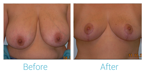 Breast Reduction Before & After Gallery - Patient 58151912 - Image 1
