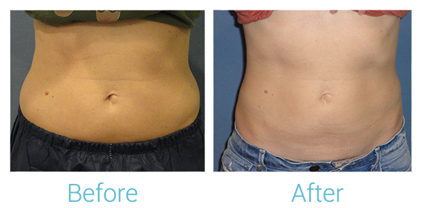 CoolSculpting Before & After Gallery - Patient 58151951 - Image 1