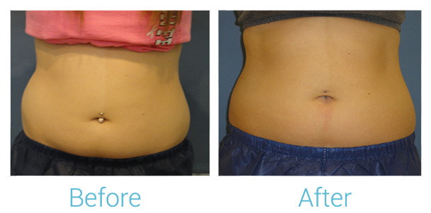 CoolSculpting Before & After Gallery - Patient 58151953 - Image 1