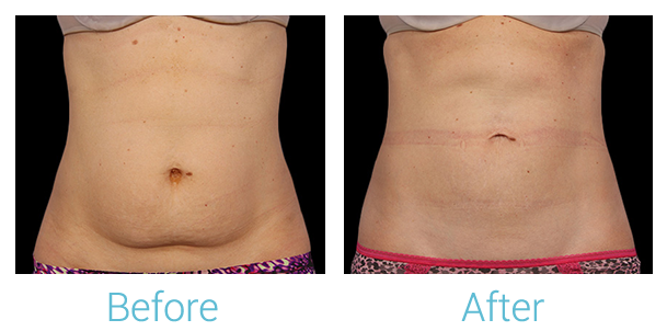 CoolSculpting Before & After Gallery - Patient 58151961 - Image 1