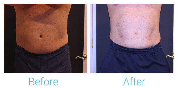 CoolSculpting Before & After Gallery - Patient 58152011 - Image 1
