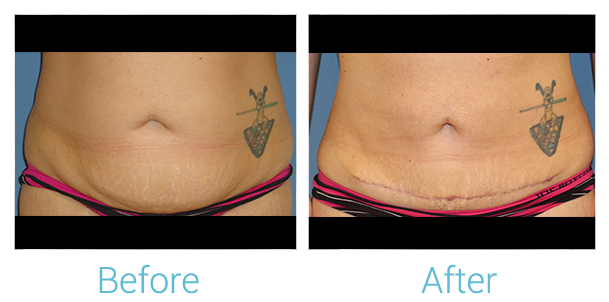 Liposuction Before & After Gallery - Patient 58152019 - Image 1
