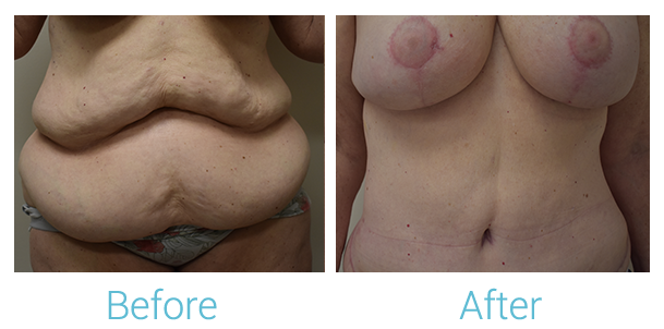 Mommy Makeover Before & After Gallery - Patient 58152026 - Image 1