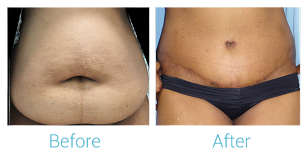 Tummy Tuck Before & After Gallery - Patient 58152055 - Image 1