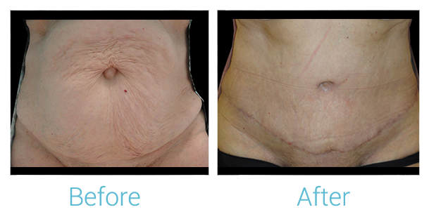 Tummy Tuck Before & After Gallery - Patient 58152061 - Image 1