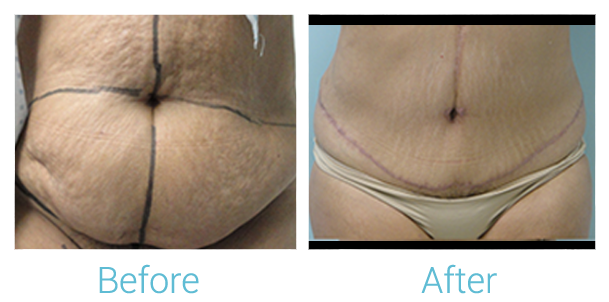 Tummy Tuck Before & After Gallery - Patient 58152062 - Image 1