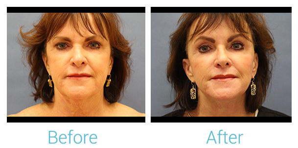 Facelift Before & After Gallery - Patient 58152101 - Image 1