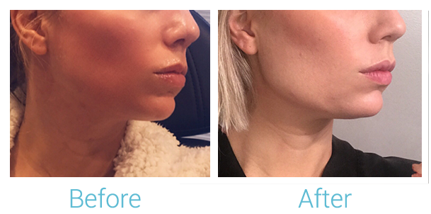 Fillers Before & After Gallery - Patient 58152117 - Image 1