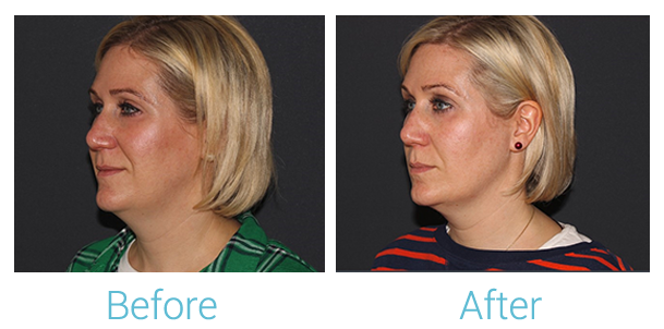 Fillers Before & After Gallery - Patient 58152118 - Image 1