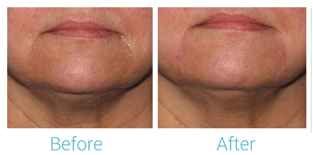 Fillers Before & After Gallery - Patient 58152119 - Image 1