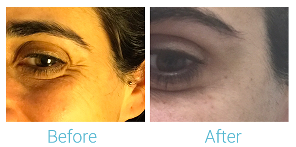 Fillers Before & After Gallery - Patient 58152125 - Image 1