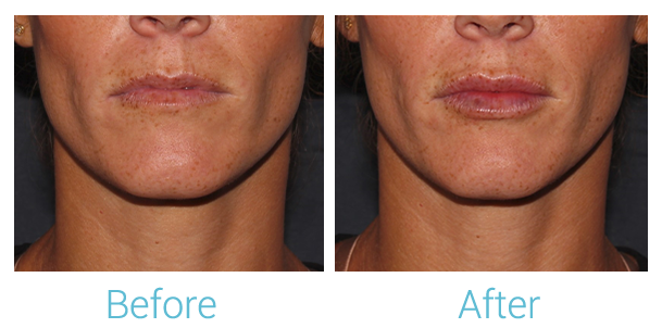 Fillers Before & After Gallery - Patient 58152126 - Image 1