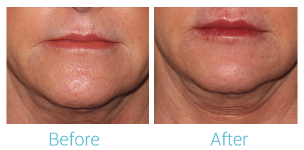Fillers Before & After Gallery - Patient 58152128 - Image 1