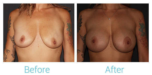 Breast Augmentation Before & After Gallery - Patient 141443990 - Image 1