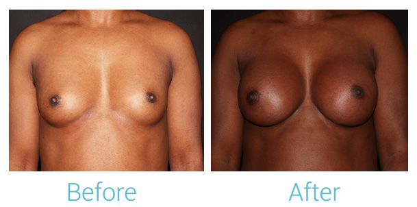 Breast Augmentation Before & After Gallery - Patient 141443988 - Image 1