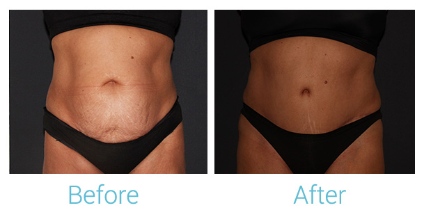 Tummy Tuck Before & After Gallery - Patient 141444565 - Image 1