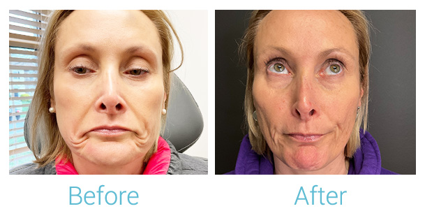 Neurotoxins (Botox, Dysport, Xeomin) Before & After Gallery - Patient 184932768 - Image 1
