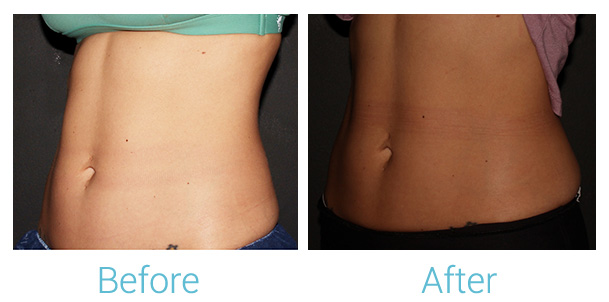 CoolSculpting Before & After Gallery - Patient 184933434 - Image 1