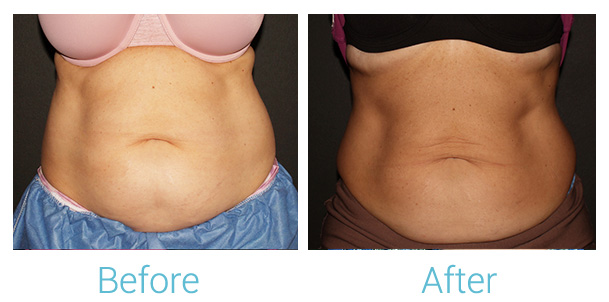 CoolSculpting Before & After Gallery - Patient 184933435 - Image 1