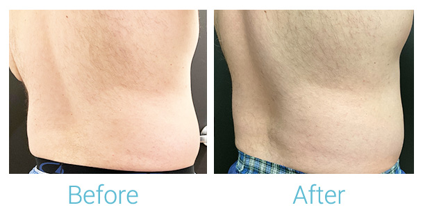 CoolSculpting Before & After Gallery - Patient 184933436 - Image 1