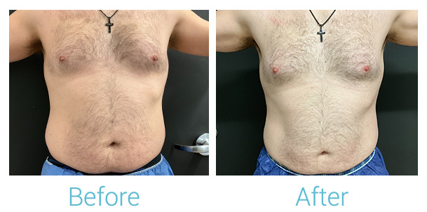CoolSculpting Before & After Gallery - Patient 184933431 - Image 1