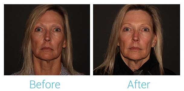 Fillers Before & After Gallery - Patient 184933301 - Image 1