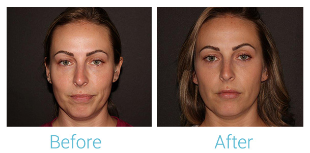 Fillers Before & After Gallery - Patient 184933303 - Image 1