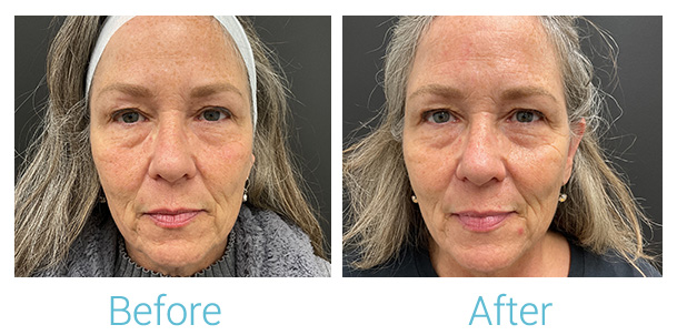 Fillers Before & After Gallery - Patient 184933300 - Image 1