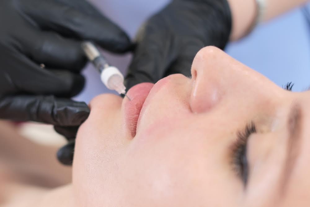 Dermal Filler Pricing in Lutherville, MD for Lips, Cheeks, and Jawline