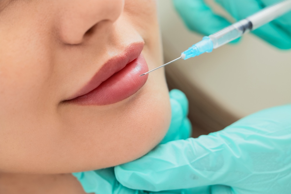 Lip Filler in Bel Air, MD: How Much Does Lip Filler Cost and How Long Do Results Last?