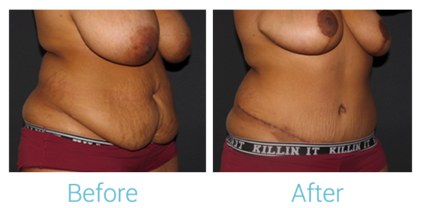 Breast Reduction Before & After Gallery - Patient 58151917 - Image 2