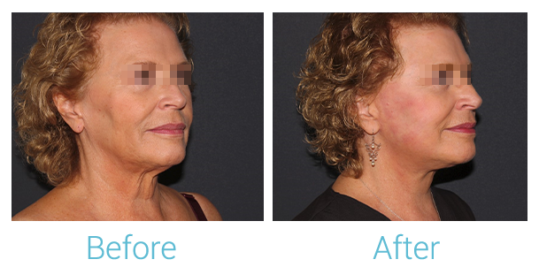Facelift Before & After Gallery - Patient 58152102 - Image 2